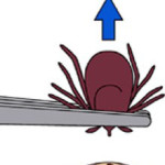 evolve medical clinics primary care and urgent care removing a tick